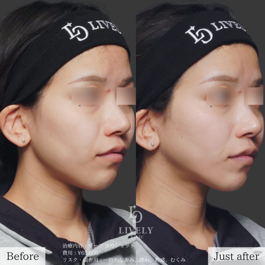 ライブリークリニックのザーフ「たるみ治療」の症例画像