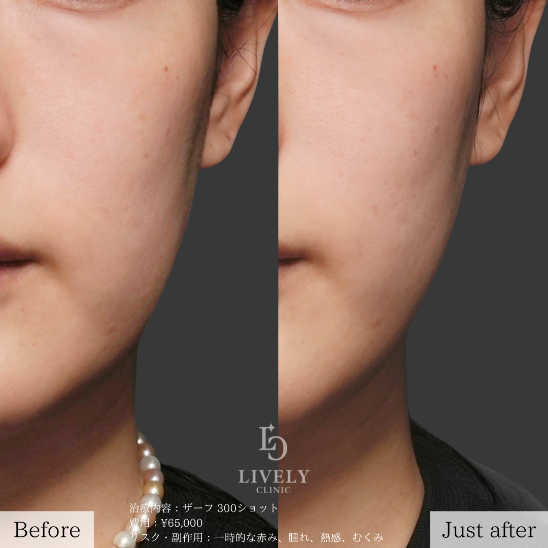 ライブリークリニックのザーフ「たるみ治療」の症例画像