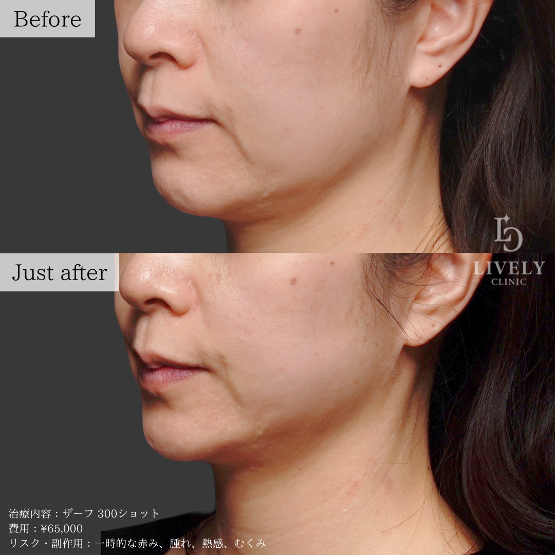ライブリークリニックのザーフ「たるみ治療」の症例画像
