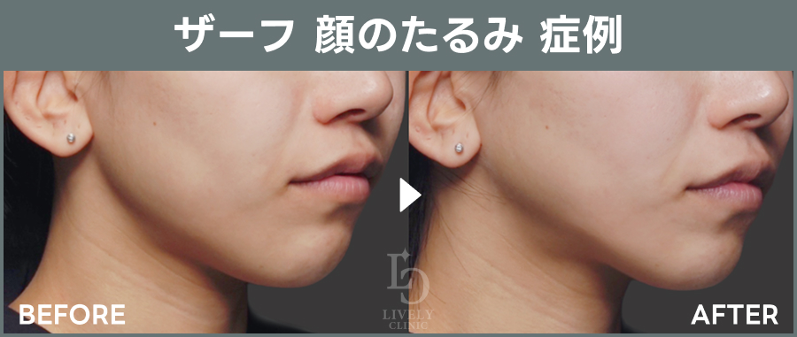 ザーフの顔のたるみの症例｜ライブリークリニック