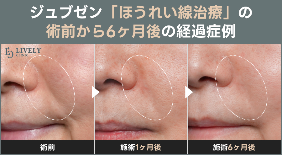 ジュブゼン「ほうれい線治療」の術前から6ヶ月後の経過症例｜ライブリークリニック