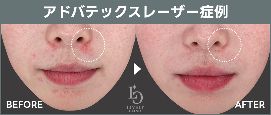 アドバテックスレーザーのBefore After｜ライブリークリニック