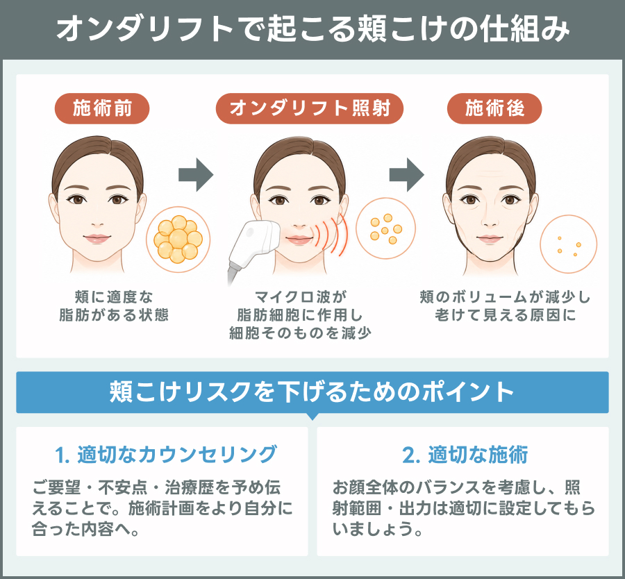 オンダリフトで起こる頬こけの仕組み｜ライブリークリニック