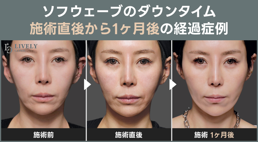 ソフウェーブのダウンタイム｜施術直後から1ヶ月後の経過症例