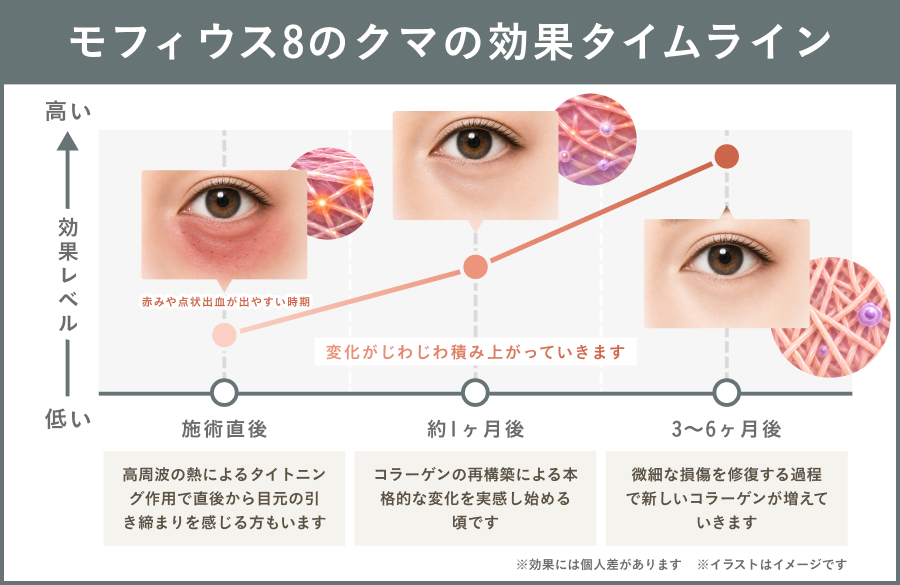 モフィウス8による目の下のクマ治療後の効果の現れ方や、経過の目安を時系列でまとめたタイムライン画像｜ライブリークリニック