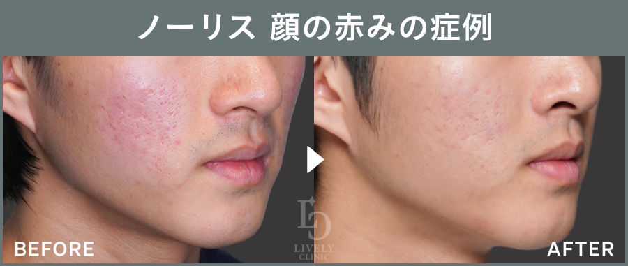 ノーリスの顔の赤みの症例｜ライブリークリニック