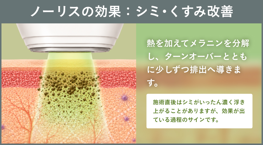 ノーリスの効果：シミ・くすみ改善｜ライブリークリニック