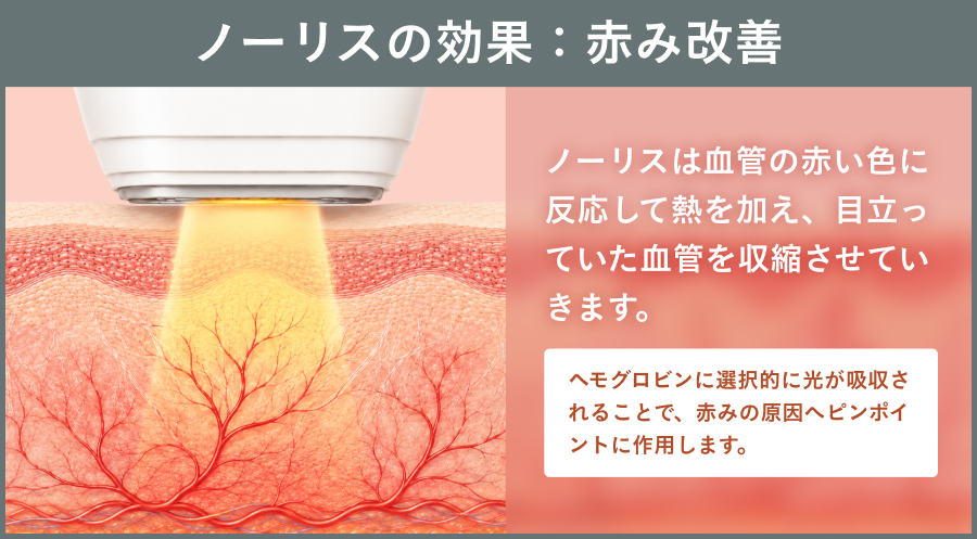 ノーリスの効果：赤み改善｜ライブリークリニック