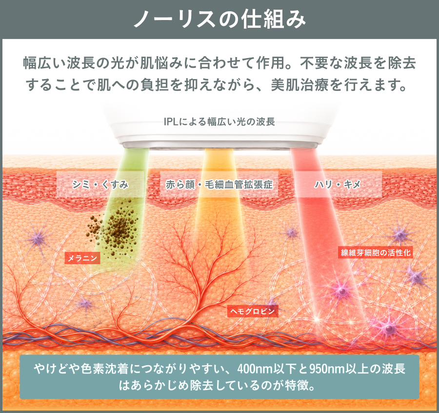 ノーリスの仕組みを解説した図｜ライブリークリニック