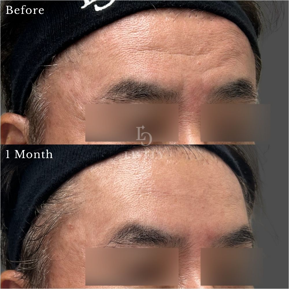 60代男性のジュブゼンによる額の刻まれたシワをケアした術前術後症例｜ライブリークリニック