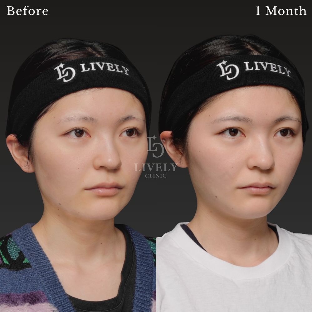 両頬のもたつきを整え自然にリフトアップした印象へ
