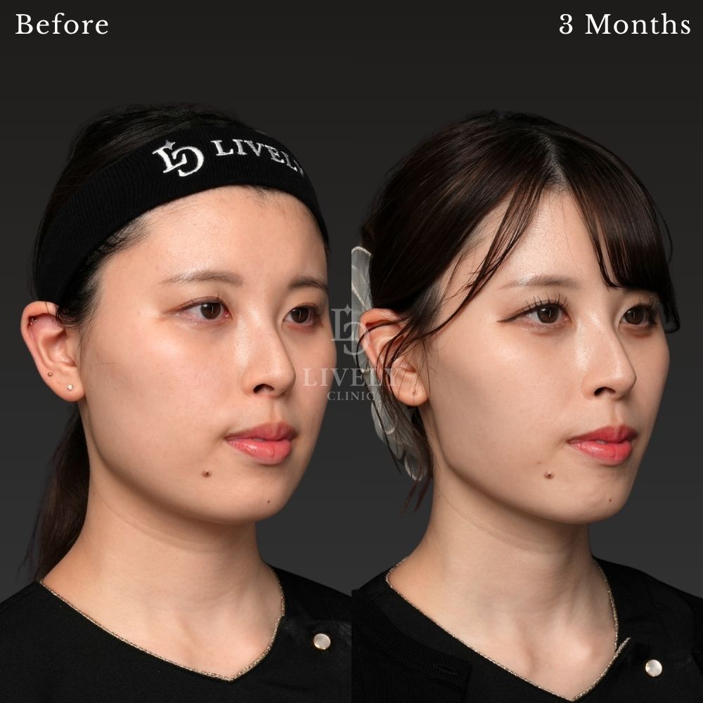クォンタムRFと脂肪吸引による両頬・顎下のボリューム感に対する術前・術後の症例｜ライブリークリニック
