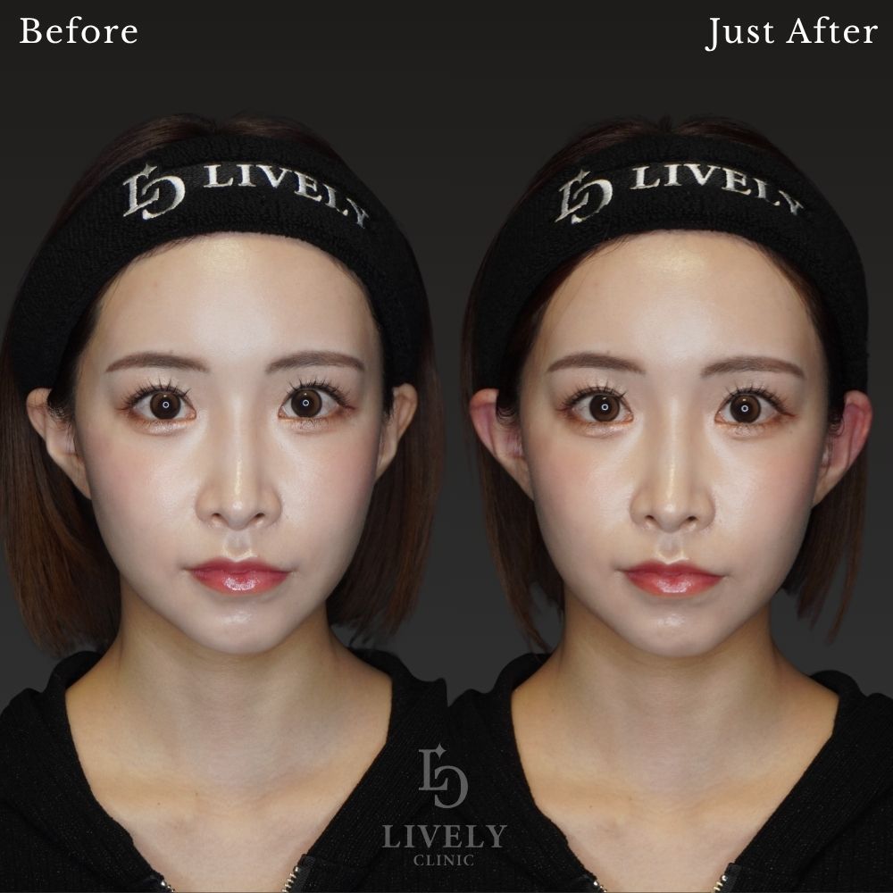 正面から見える耳を整え、華やかで自然な印象へ